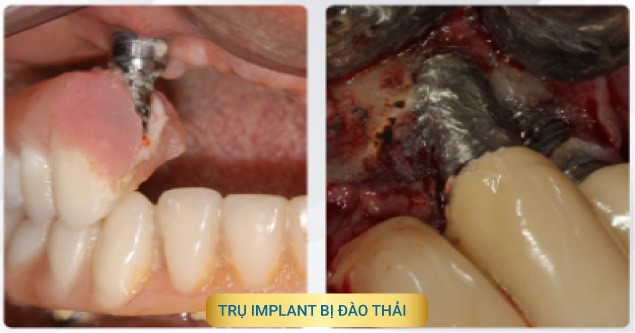 Trụ Implant Bị Đào Thải Do Kém Chất Lượng
